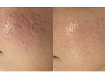 ブブオム 恵比寿本店(BUB OMME)/サーマトリックス