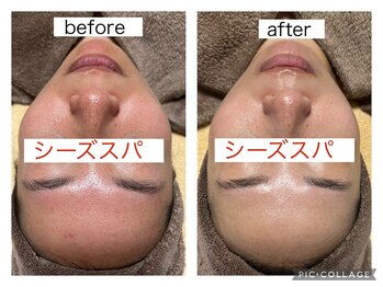 ヘルスアンドビューティー シーズスパ(CSY's SPA)/ハーブピーリングで赤み改善