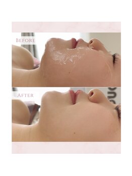 メロウ(mellow)/光フェイシャルでハリツヤ肌に♪