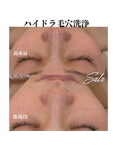 サラ/ハイドラ毛穴洗浄