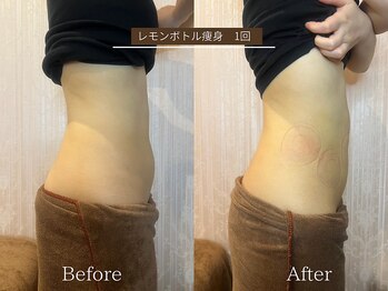 スマイルビューティラボ 別府店(Smile Beauty lab.)/レモンボトル痩身☆