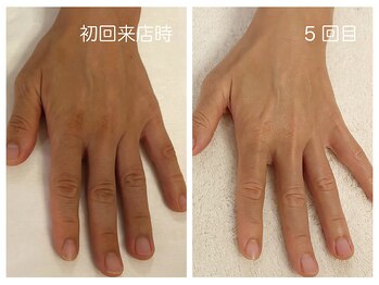 キレイテ 上野店/50代/5回目【ハンドケア稲荷町】