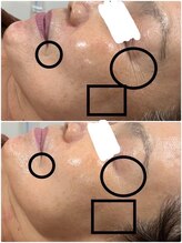 ビトタン 倉敷本店(+美to鍛)/ハーブピーリング/10回目