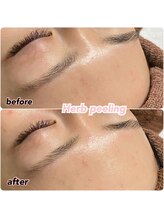 アンリミテッド ビューティールーム(UNLIMITED BEAUTYROOM)/-ハーブピーリング-