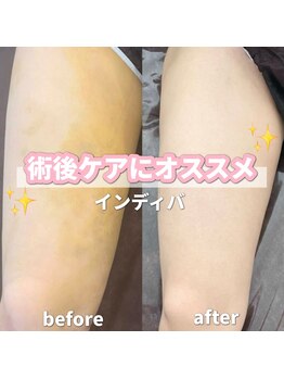 サロン(SALON)/インディバ75分