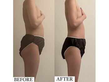 フェミニー(Feminy)/5回でお腹！！痩身！