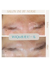 サロン イニ(SALON INI)/《ワイコ水光ピール症例》