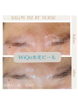 サロン イニ(SALON INI)/《ワイコ水光ピール症例》