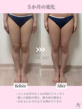 プラスワンビューティテン 新大阪店(Plus One Beauty)/ボディ/ハイパーナイフ/痩身