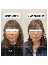 オン鍼灸整体院(ON鍼灸整体院)/美容鍼灸/ビフォーアフター