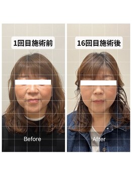 オン鍼灸整体院(ON鍼灸整体院)/美容鍼灸/ビフォーアフター