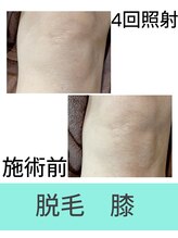 エミナル(EMINAL)/膝脱毛の効果！脱毛/全身脱毛/