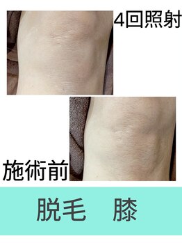 エミナル(EMINAL)/膝脱毛の効果!脱毛/全身脱毛/