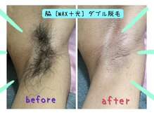 ジョエルワックス 沖縄コザ店(JOELLE WAX)/メンズ★脇ダブル脱毛