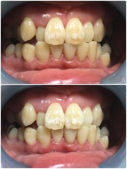 カルム(Calme)/セルフホワイトニング