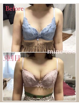 マイントゥー(mine too)/バストアップ症例