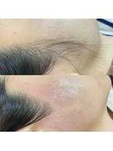 アロー(Allo!)/もみあげWAX脱毛