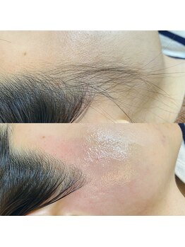 アロー(Allo!)/もみあげWAX脱毛