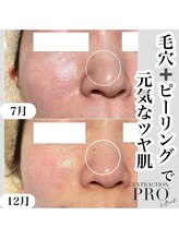 ルアナ(Luana)/【シリカ＋毛穴コース】