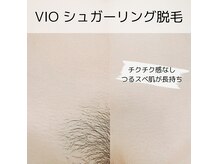 シュガーリング脱毛は、その日からつるスベ肌【VIO初回\4,900】