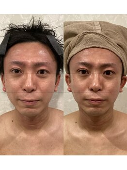 ラバ 名古屋栄店(LAVA)/小顔コルギ【むくみケア】