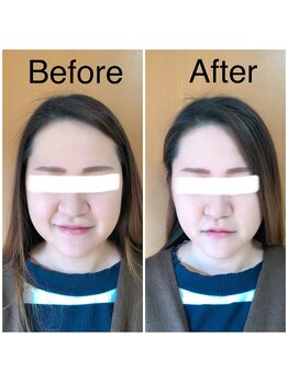 カイロプラクティック ネクサス/顔とあごの歪み撃退☆