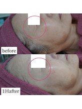 アップルミント/＜フェイシャル＞before・after