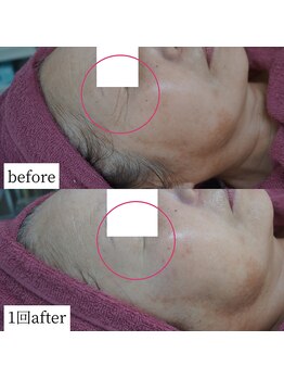 アップルミント/＜フェイシャル＞before・after