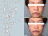 【西日本初取扱店】LDMリフティング+幹細胞培養上精液+光フォト<小顔/リンパ>
