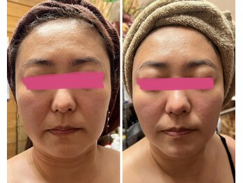 オルオル(Olu'olu)/超音波小顔フェイシャル