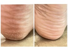 オッペンプラザ アルーリング(oppen plaza Alluring)の雰囲気(気になるフェイスラインをスッキリさせると横顔もキレイです)