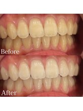 ホワイトニングカフェ 吉祥寺店(WhiteningCafe)/8回コース / ビフォーアフター