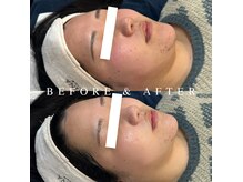 パリスヒロトン(PARIS HIROTON)の雰囲気（白玉リフティングは、肌質を強くするだけでなく、小顔効果も◎）