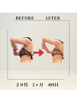 フェムビー 千葉駅前店(FEMBE)/痩身）20代の方の変化
