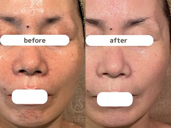 サンゴ(Sango)/毛穴/シミ/たるみ改善