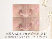 アネラボーテ(Anela Beaute)/セラピール1回目★黒ずみ改善