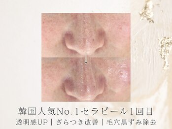 アネラボーテ(Anela Beaute)/セラピール1回目★黒ずみ改善