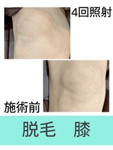 エミナル(EMINAL)/膝脱毛の効果！脱毛/全身脱毛/