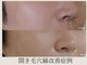 リトルーム(Litroom: from Seoul)の写真/【韓国女優肌エステ】毛穴気になるお肌向け/肌質改革,毛穴特化型ケア