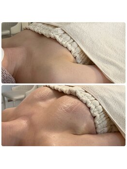 カナエルサロン 旭川(KANAERU SALON)/【バストケア】症例☆