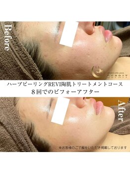 エスプリ 銀座店/ハーブピーリングI銀座