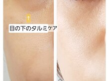 マロン(MARON)/ハーブピーリング