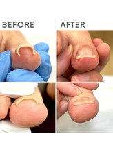 クオッカ(Quokka)/巻き爪ケア