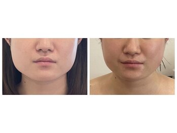 スターティス(STATICE)/小顔・骨格矯正