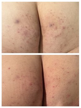 エミルカ 自由が丘店(EMILUCA)/おしり ハーブピーリング