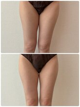 ラブランフェアリー/ヒップ引上げで変わる太もも