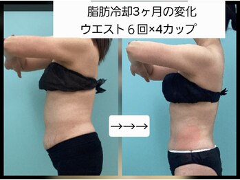 ステラ(Stella)の写真/最新マシンによる脂肪冷却と、代謝を上げ排出を促す温熱リンパのWアプローチ!気になるお悩みを集中ケア◎