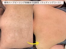 育肌美研 自由が丘サロン/背中ニキビケアハーブピーリング