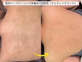 育肌美研 自由が丘サロン/背中ニキビケアハーブピーリング
