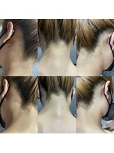 メンズー(MENZOO)/うなじ脱毛